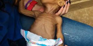 "UN DOLOR QUE NUNCA SUPERARÁS"  The Guardian: Bebés en Venezuela mueren de desnutrición